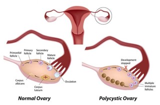 What is PCOS Treatment or polycystic ovary syndrome?